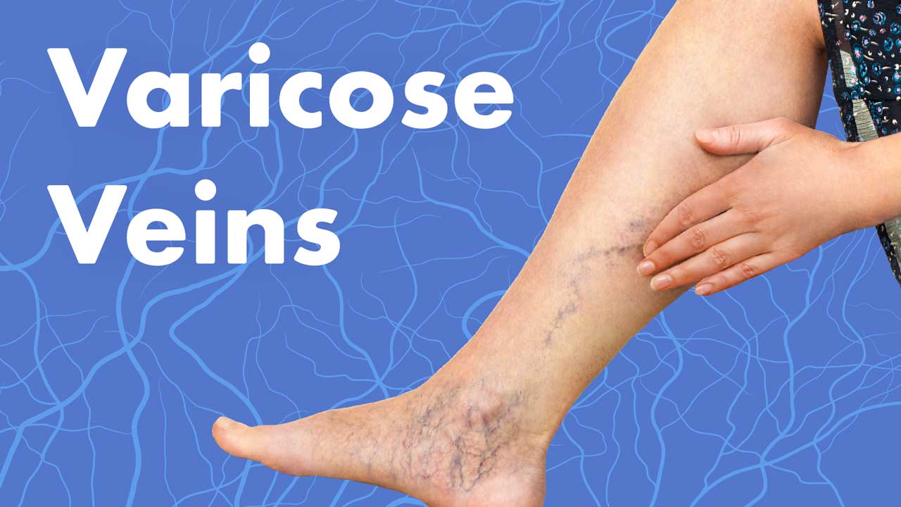varicose veins