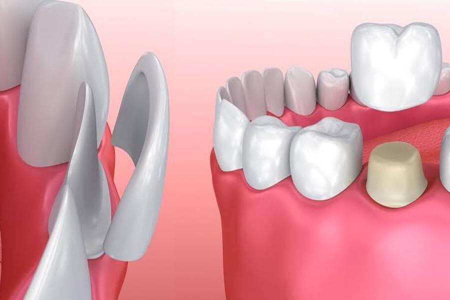 Tooth loss