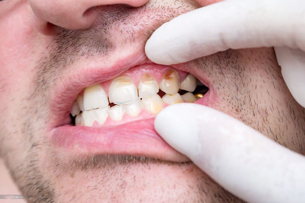 tooth decay