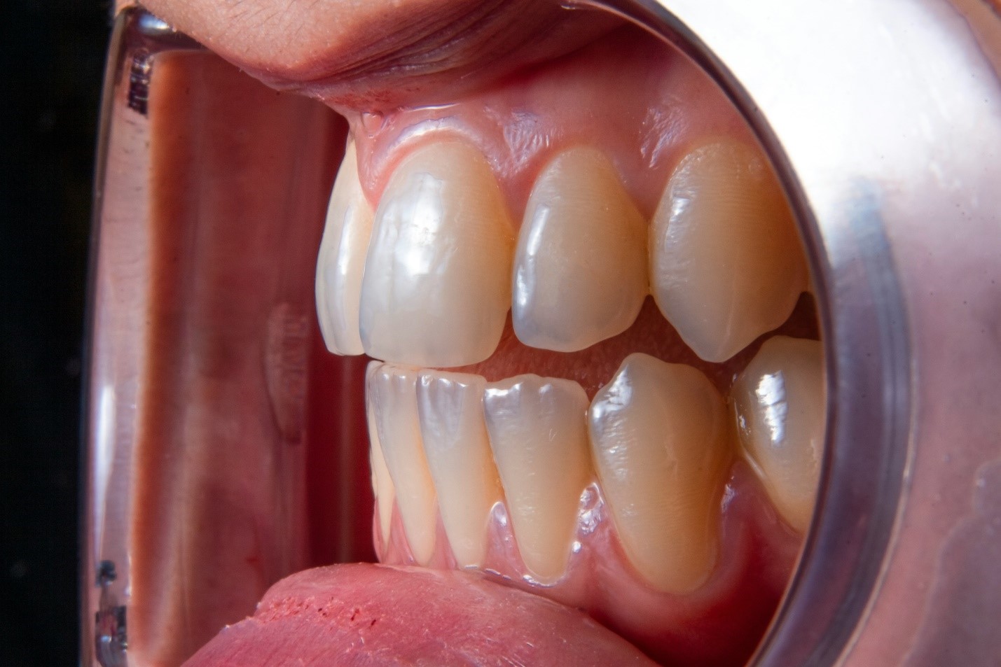 Composite Bonding